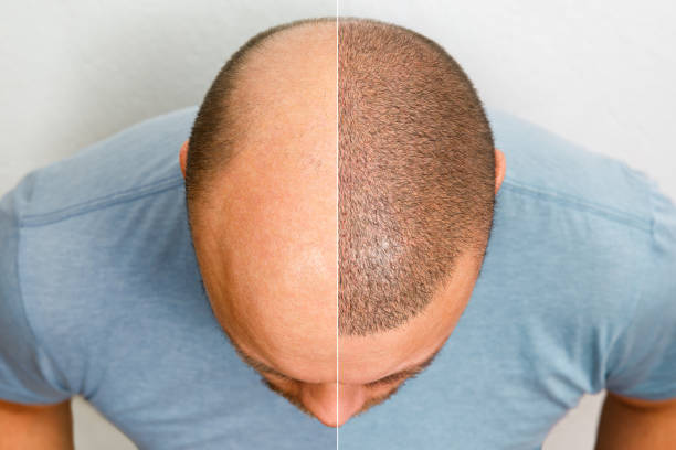 Les personnes optent souvent pour une greffe dans le but d’obtenir un résultat naturel. En effet, l’aspect visuel joue un rôle clé.